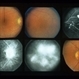 Eales Disease Eales Disease